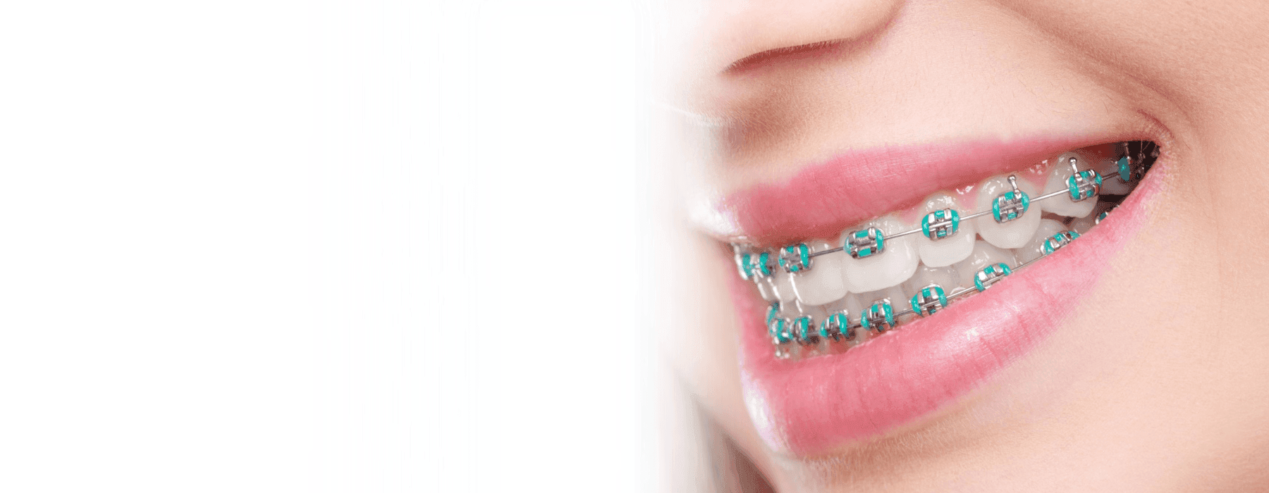 Braces | Orthodontist